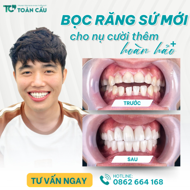 quy trinh boc rang su chuan y khoa tai nha khoa toan cau 1