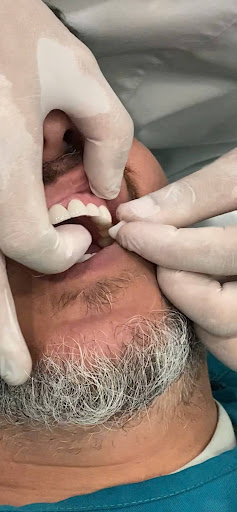 quy trinh boc rang su chuan y khoa tai nha khoa toan cau 3