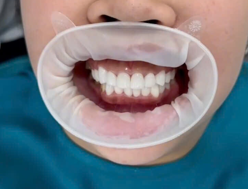 quy trinh boc rang su chuan y khoa tai nha khoa toan cau 6