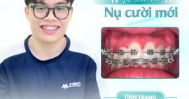 Có nên niềng răng không? 7 lợi ích khiến bạn thay đổi quyết định