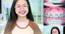 Độ tuổi thích hợp để niềng răng là bao nhiêu?