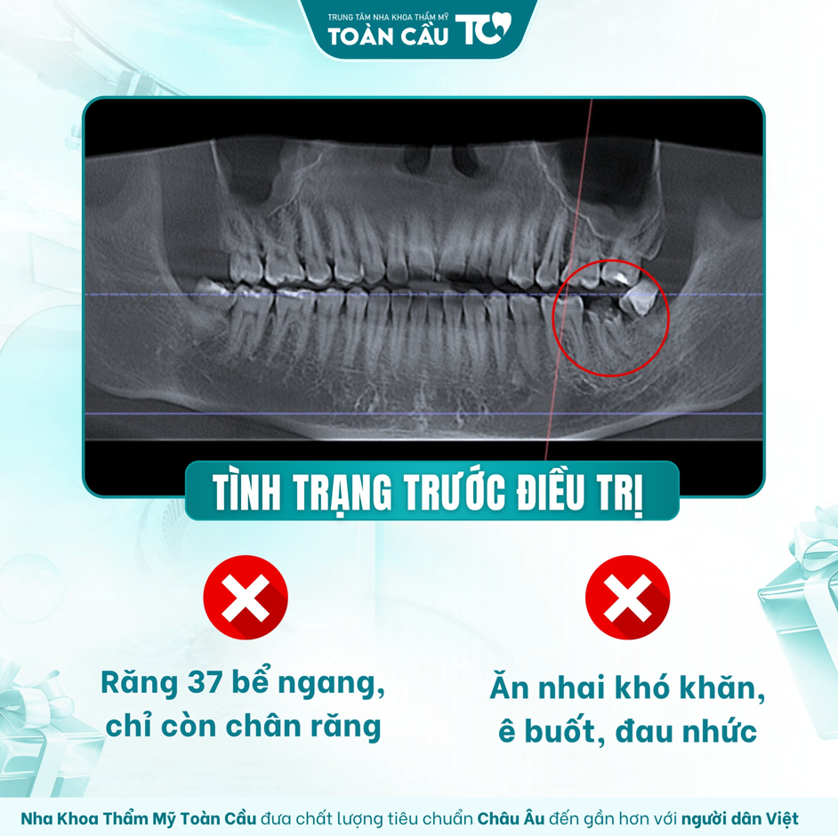 trong rang implant co anh huong than kinh khong giai dap chi tiet 1