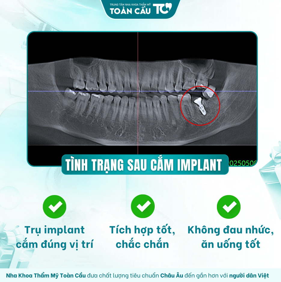 trong rang implant co anh huong than kinh khong giai dap chi tiet 2