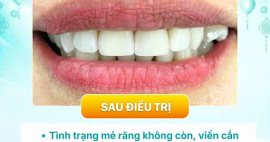 Veneer có bị đổi màu không? Sau 5–10 năm răng trông thế nào?