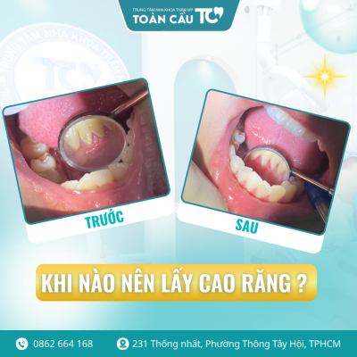cao rang la gi co nen lay thuong xuyen khong 1