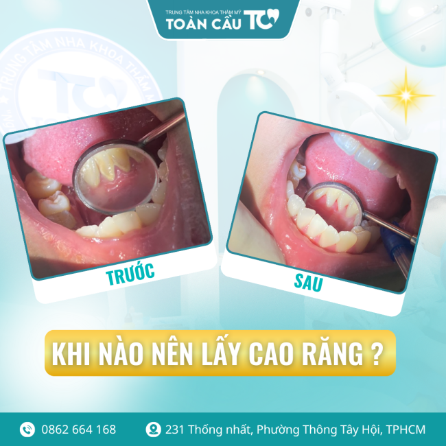 cao rang la gi co nen lay thuong xuyen khong 1