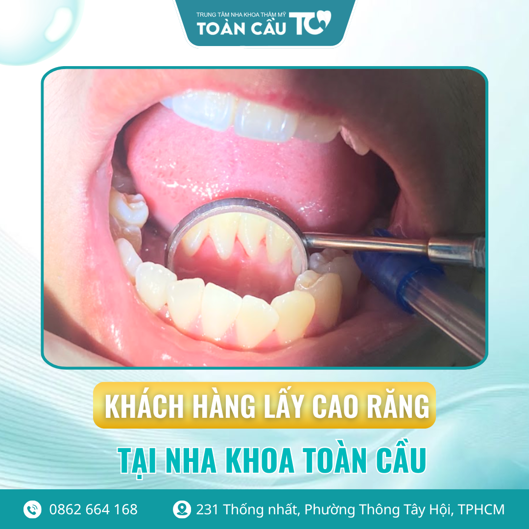 cao rang la gi co nen lay thuong xuyen khong 2