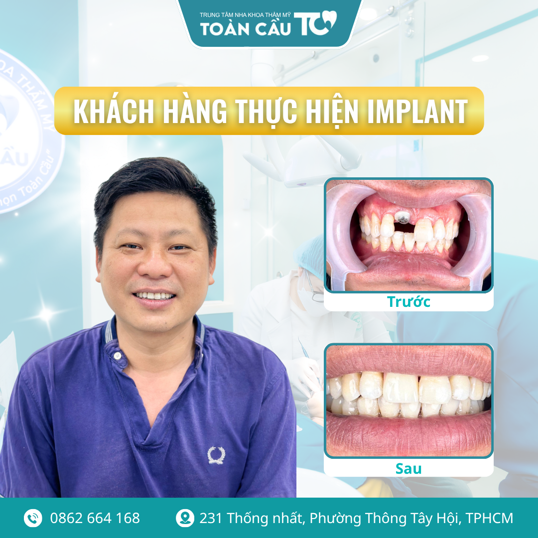 cay implant co bien chung khong 5 quy tac vang de phau thuat an toan 2