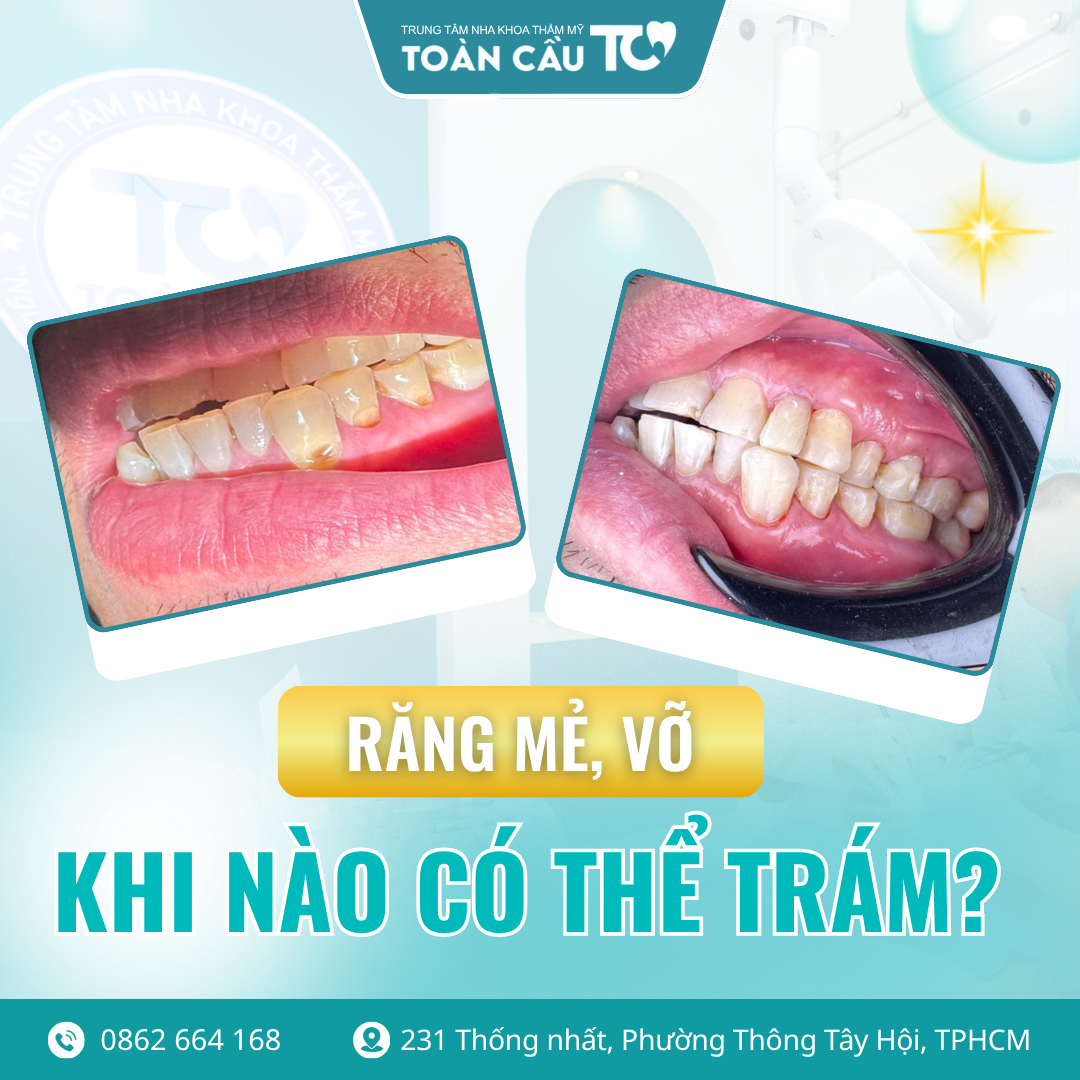 rang bi vo co tram lai duoc khong 1