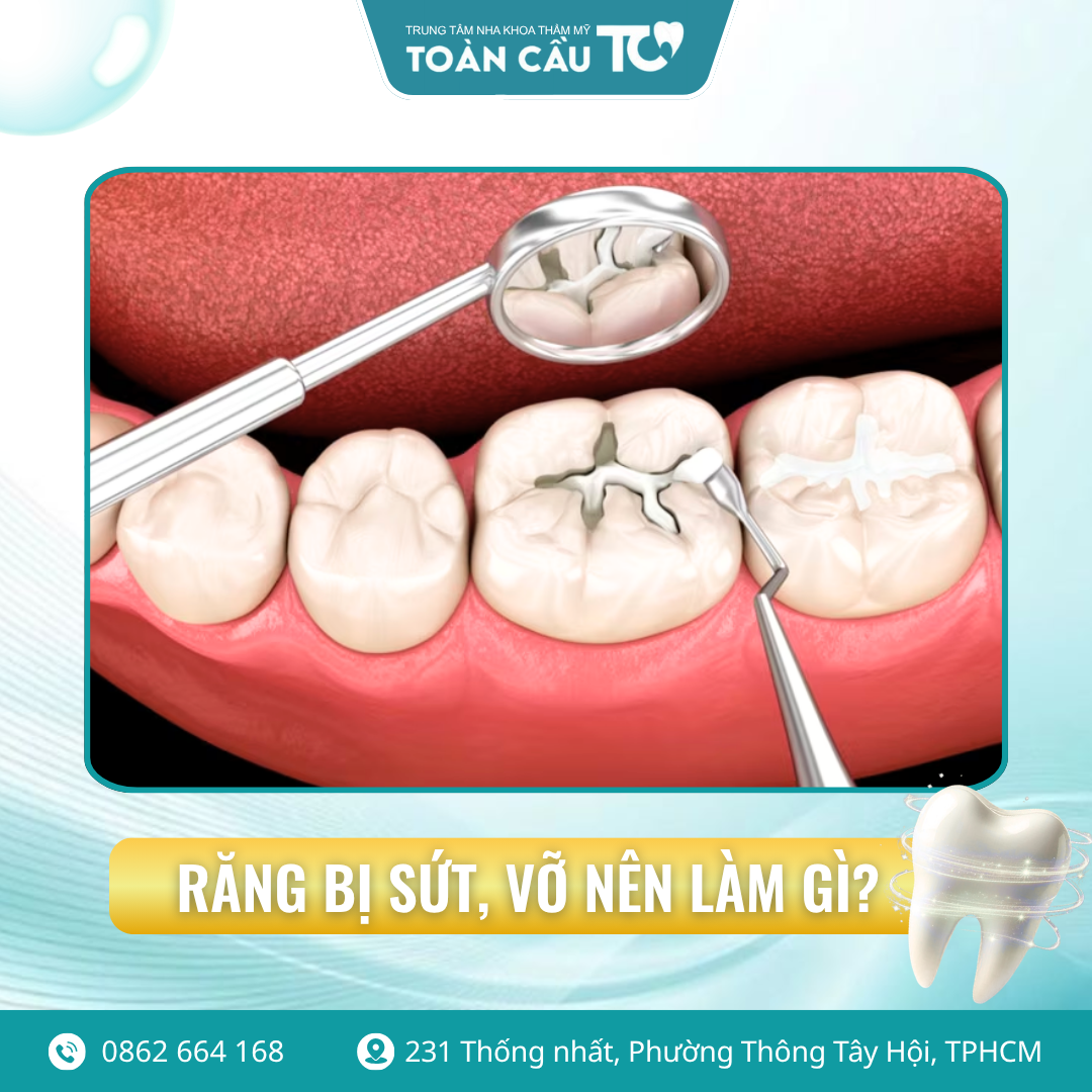 rang bi vo co tram lai duoc khong 3