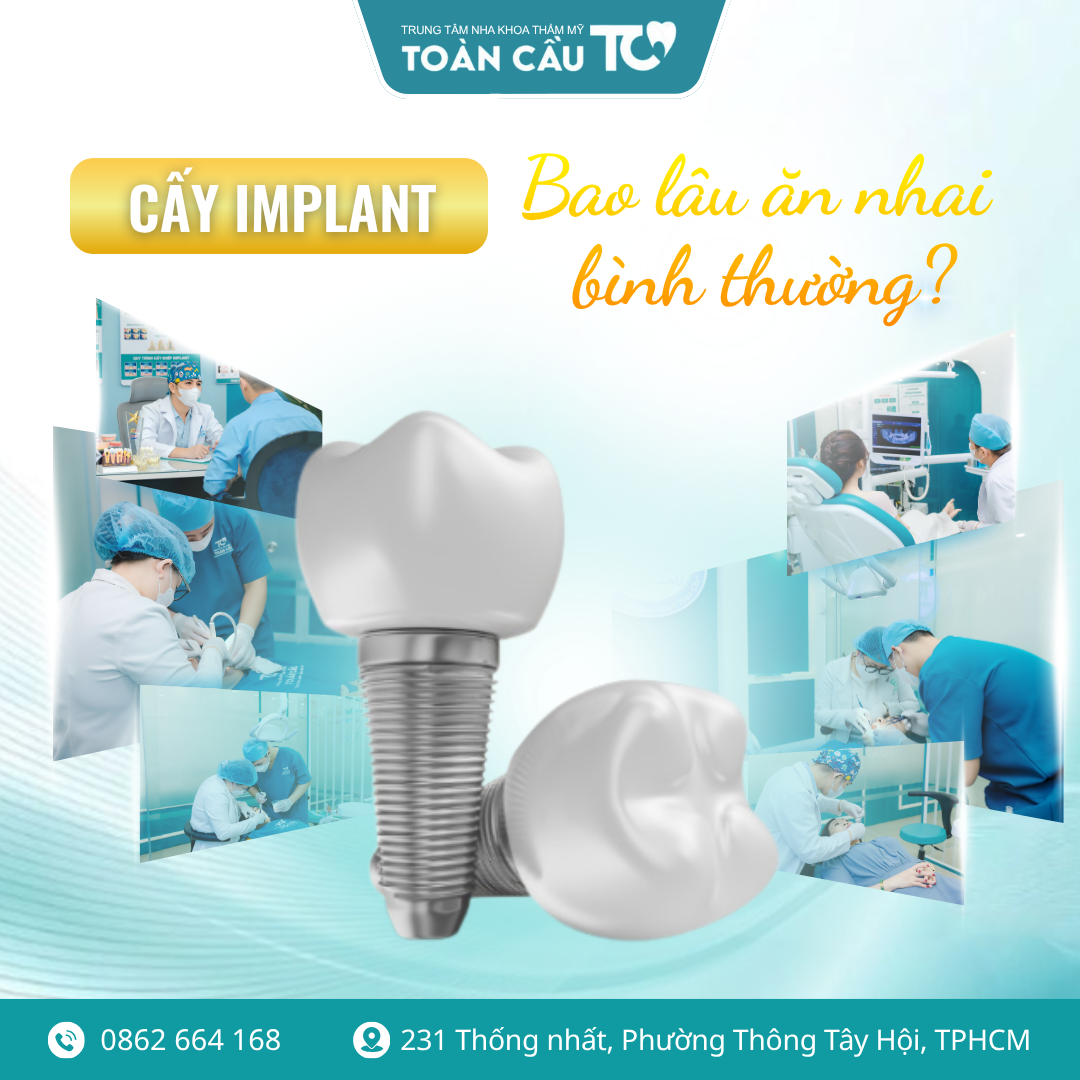 sau khi cay implant bao lau an nhai binh thuong lo trinh hoi phuc tu a z 1