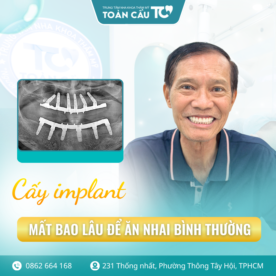 sau khi cay implant bao lau an nhai binh thuong lo trinh hoi phuc tu a z 2