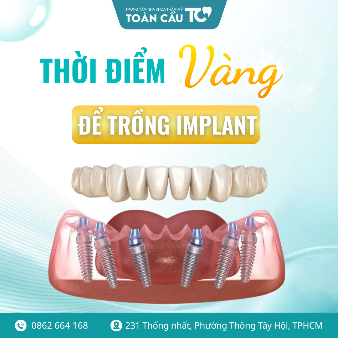 sau nho rang bao lau thi trong implant thoi diem vang de tiet kiem chi phi 3